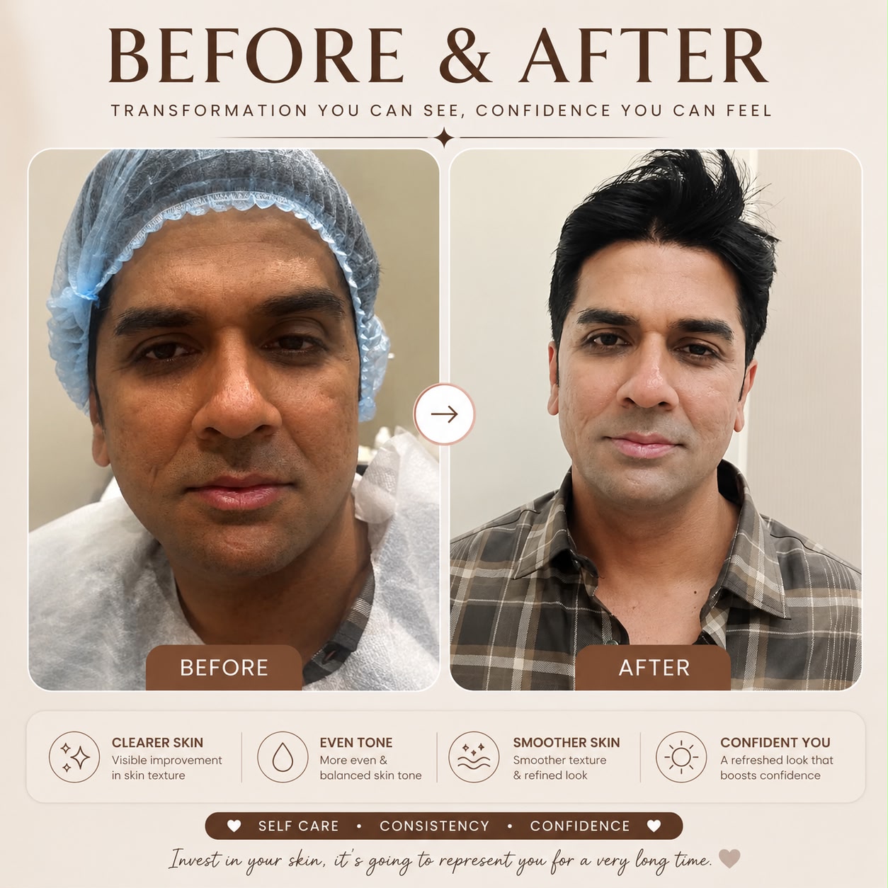 Skin rejuvenation - Before and After treatment at Aura Clinic